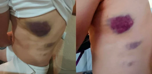 FOTO: Studenti u blokadi objavili fotografiju modrica za koje tvrde da su nastale tokom policijskog zadržavanja nakon Vidovdana